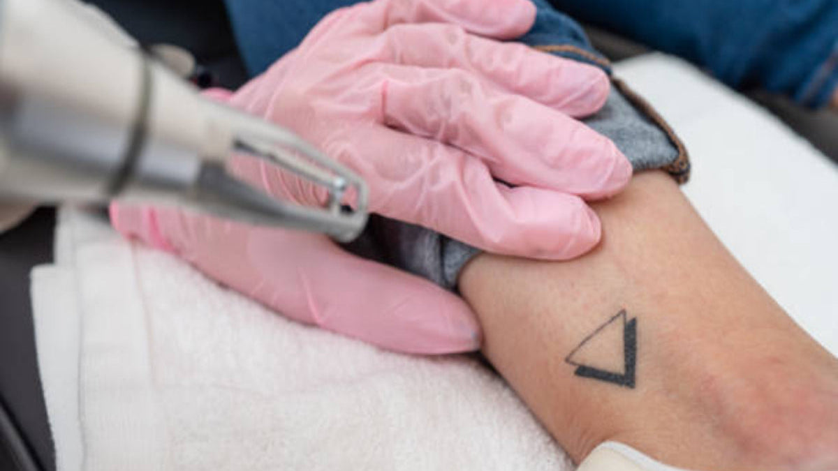 A person receiving tattoo removal treatment using laser technology.
