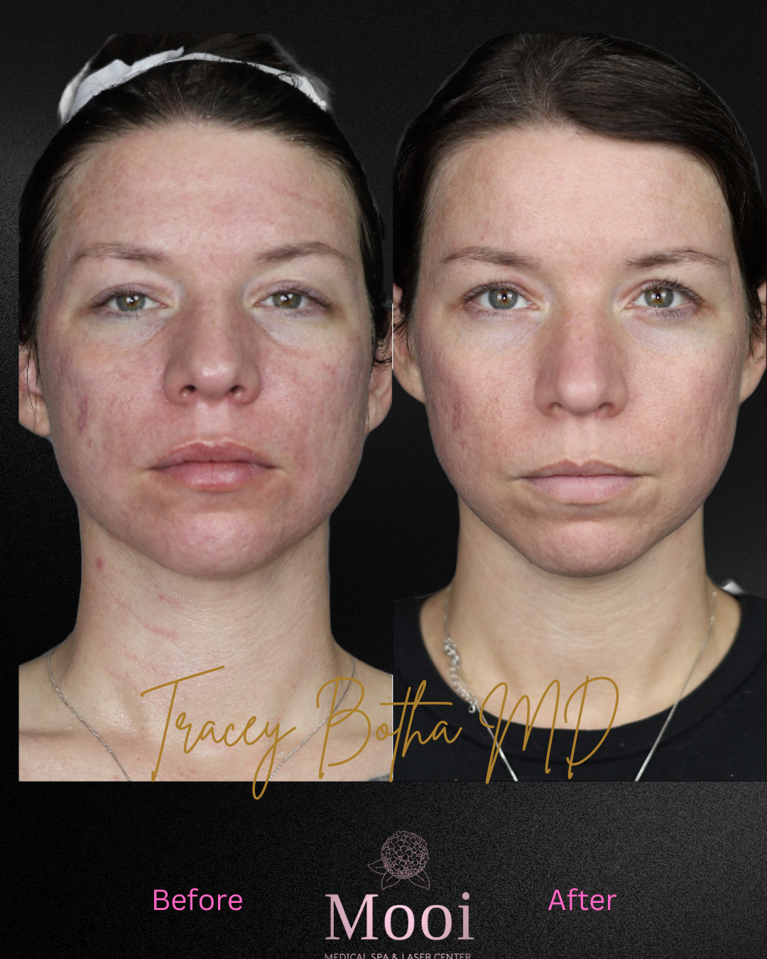 Microneedling/Radiofrequency Treatment
