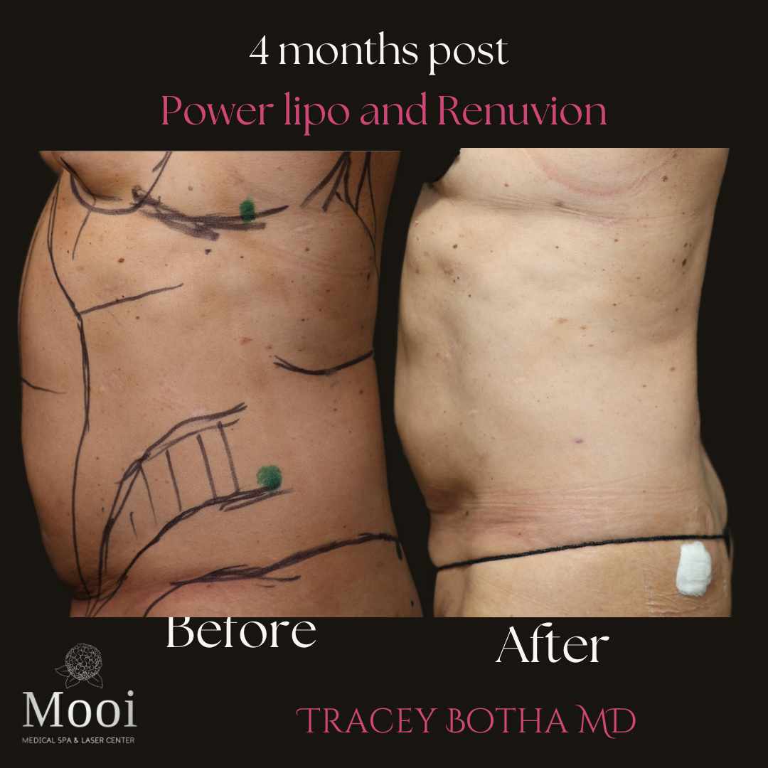 before and after of abdomen side profile with markings for  surgery