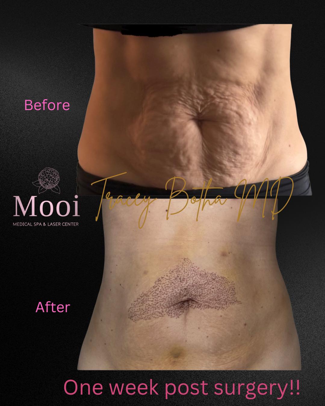 front view of womans torso after liposuction with plexr laser treatment
