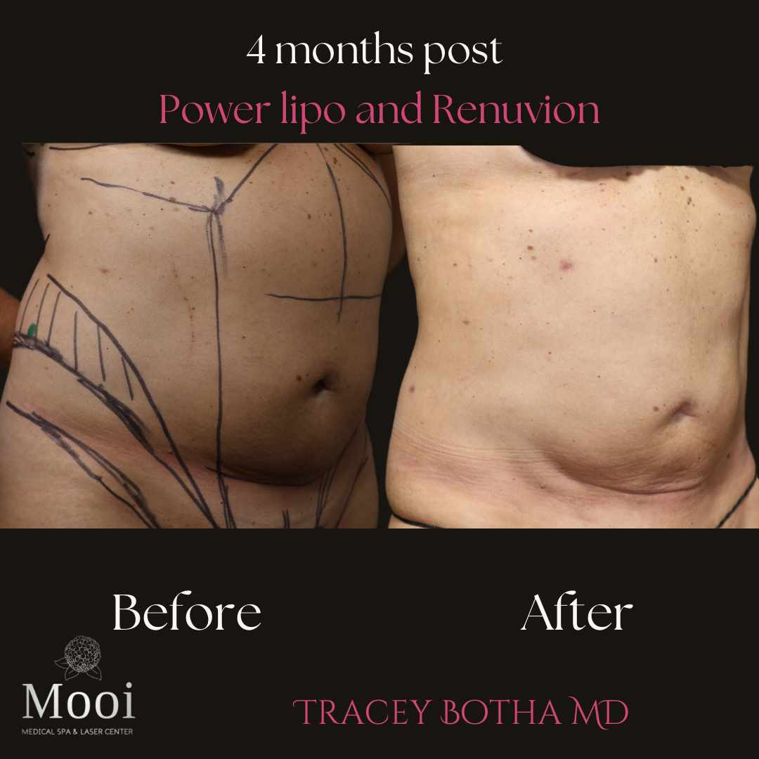 before and after abdomen liposuction with markings