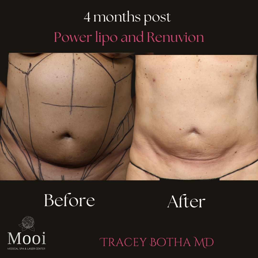 before and after of abdomen for lipo 