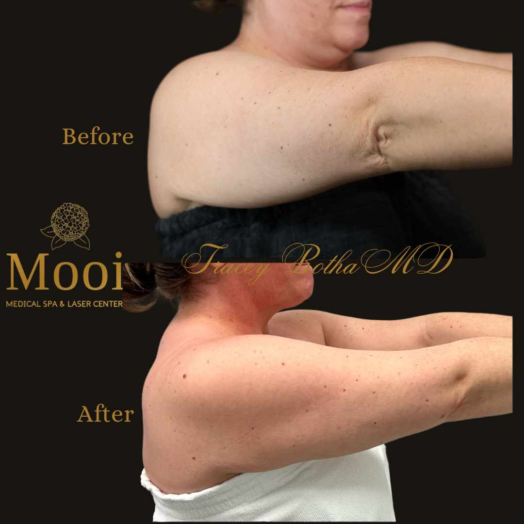 before and after of a woman holding her arms out to show skin tightening of the arms right side