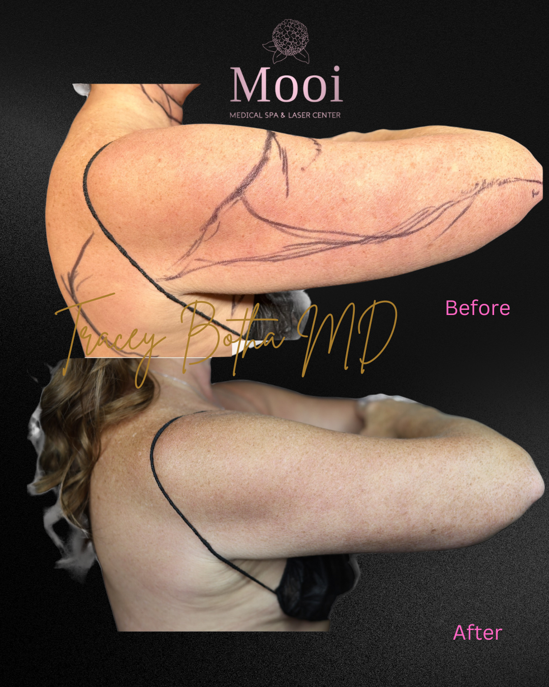 side profile of arms crossed and lines marking a before and after of liposuction