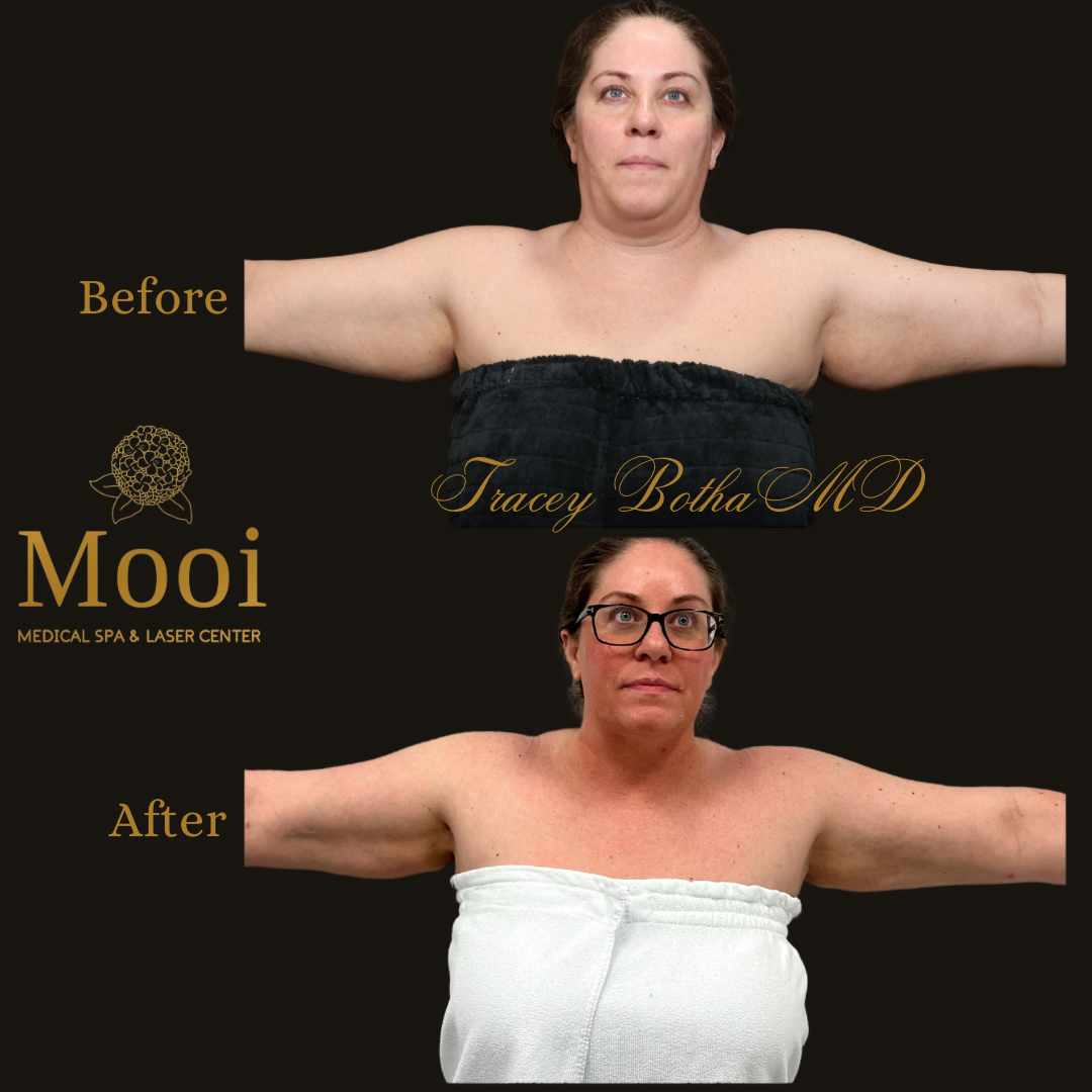 before and after of a woman holding her arms out to show skin tightening of the arms 