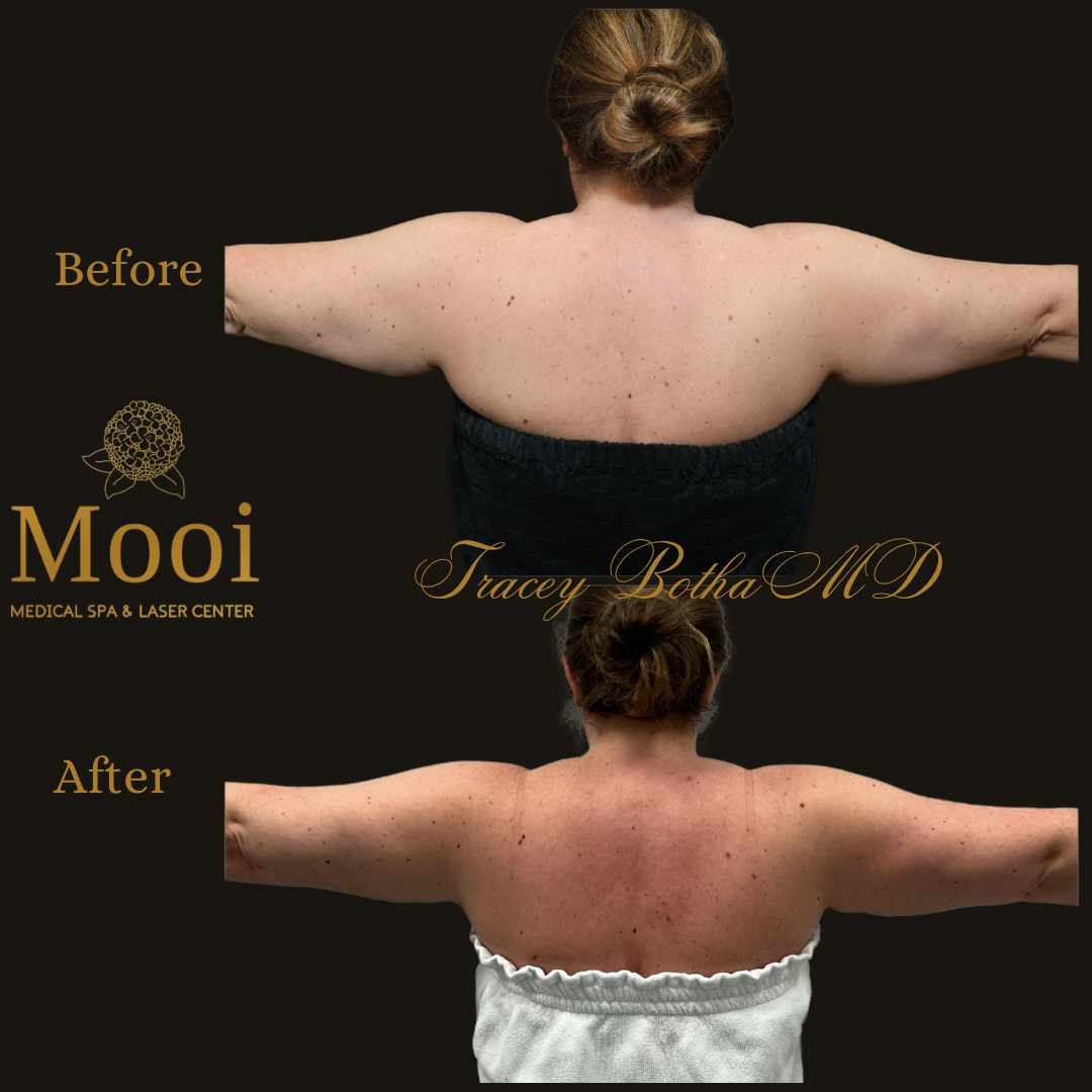before and after of a woman holding her arms out to show skin tightening of the arms  from the back