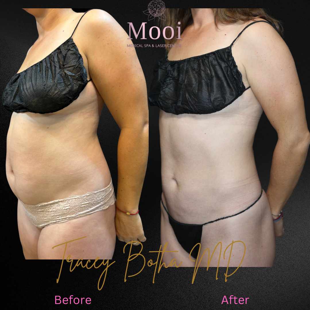 before and after of body sculpting on young woman torso