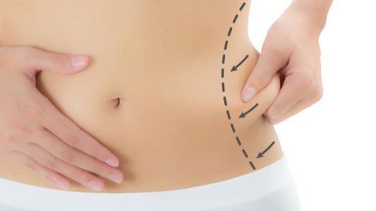 A person marking another person's abdomen with a dotted line indicating a potential surgical body sculpting procedure.