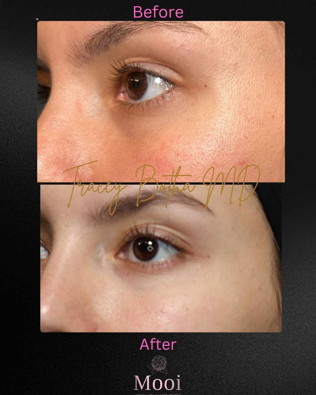 Botox