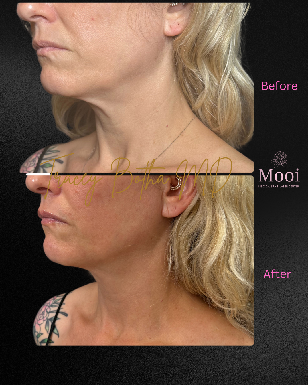 blonde patient before and after neck botox 