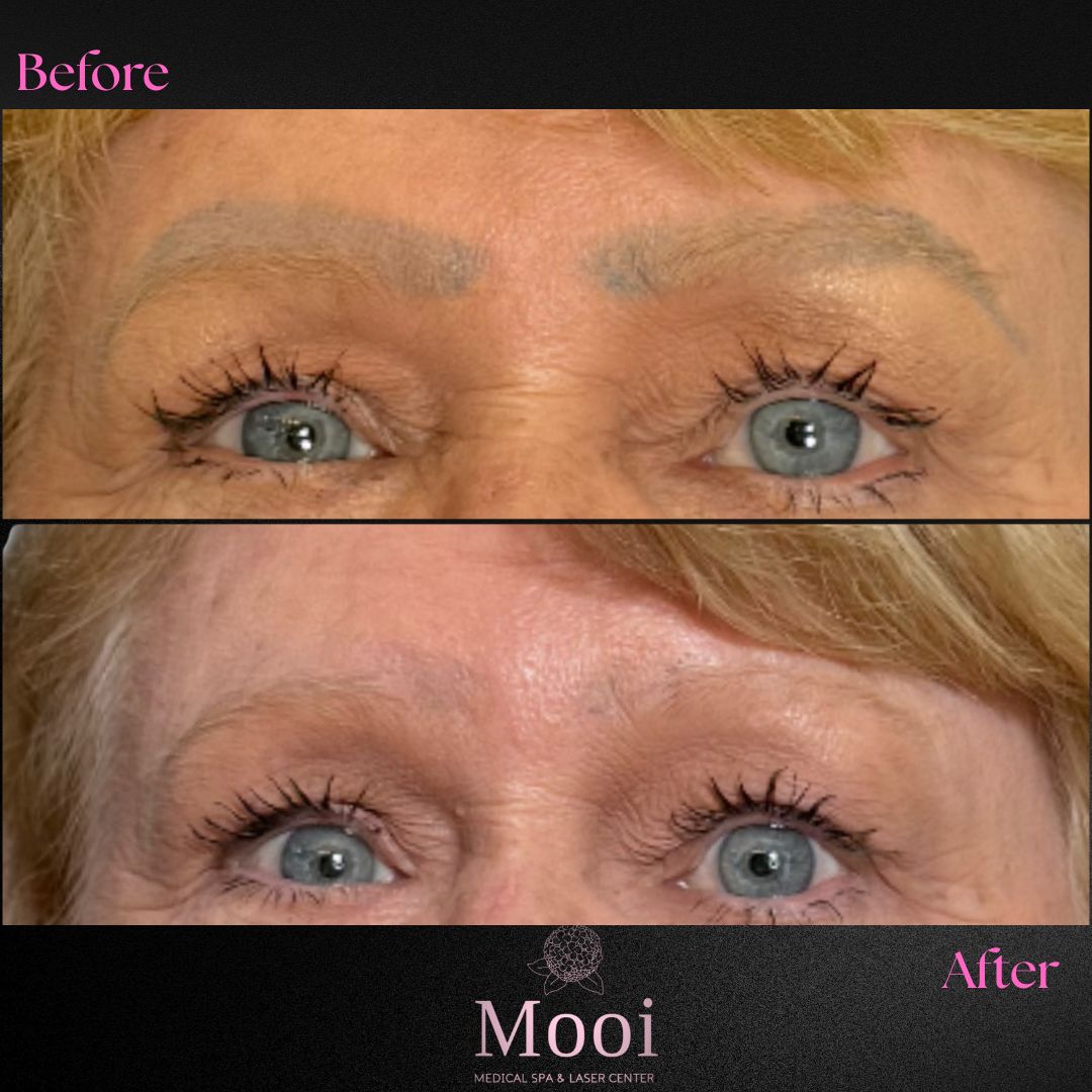 Before and after comparison of a woman's eyebrows for tattoo removal with Mooi branding.