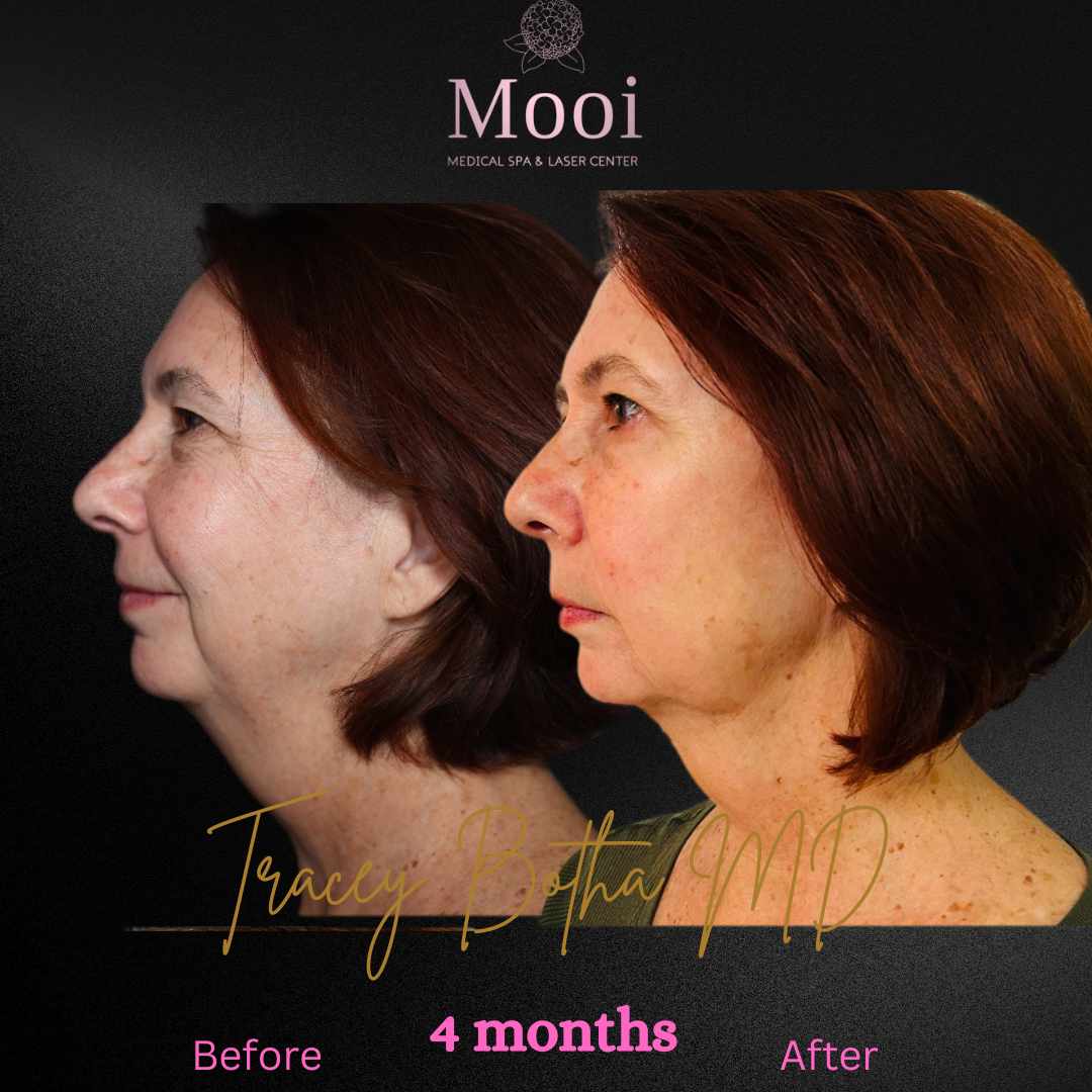 before and after image of neck tightening on middle age woman side profile 