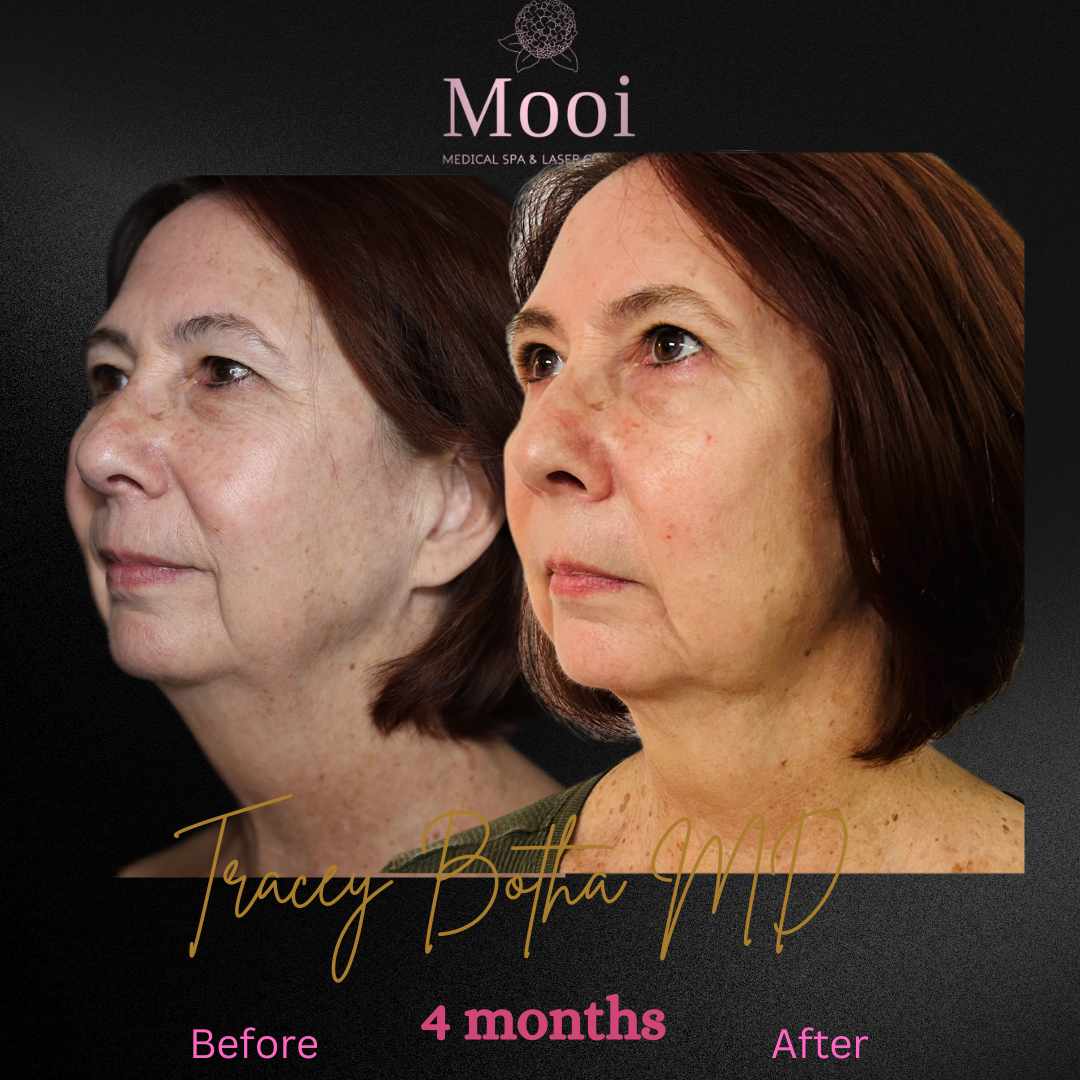 before and after image of neck tightening on middle age woman angle profile