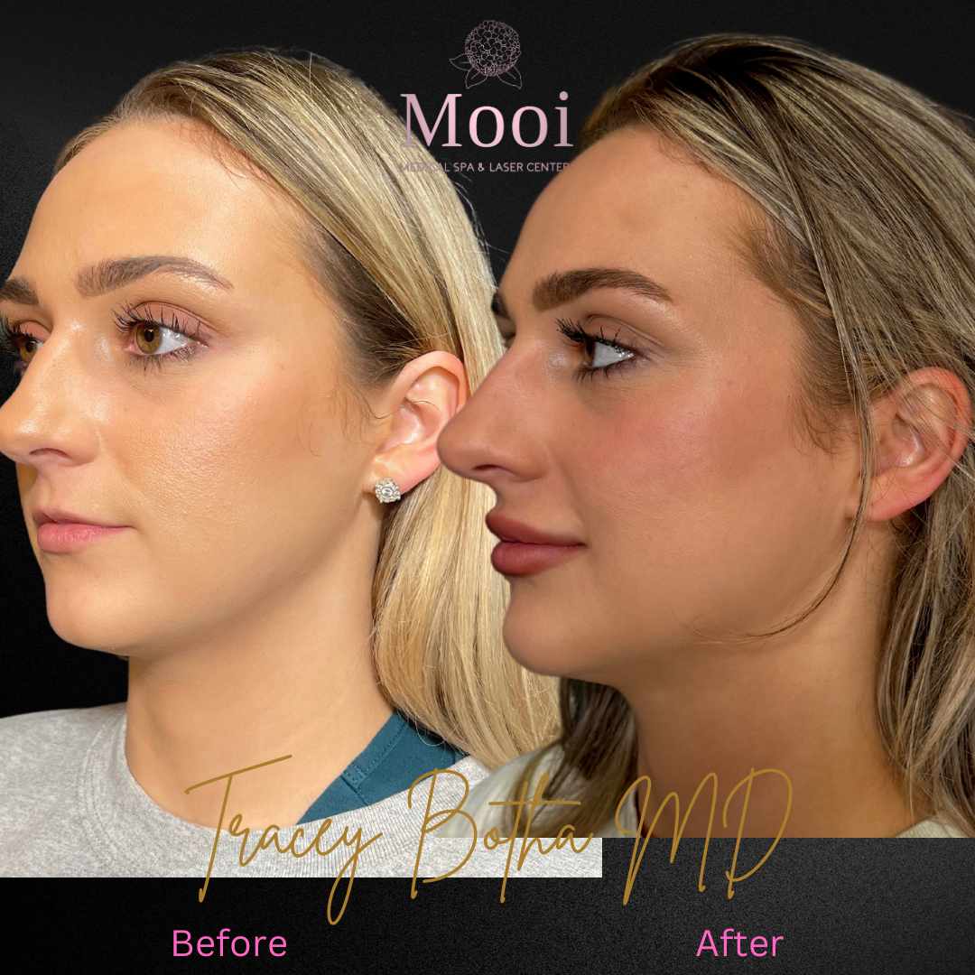 before and after of young woman with filler side profile 