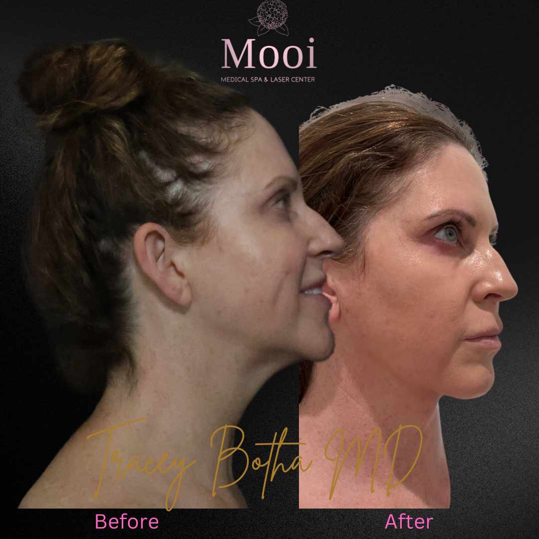 Lipo & Renuvion
