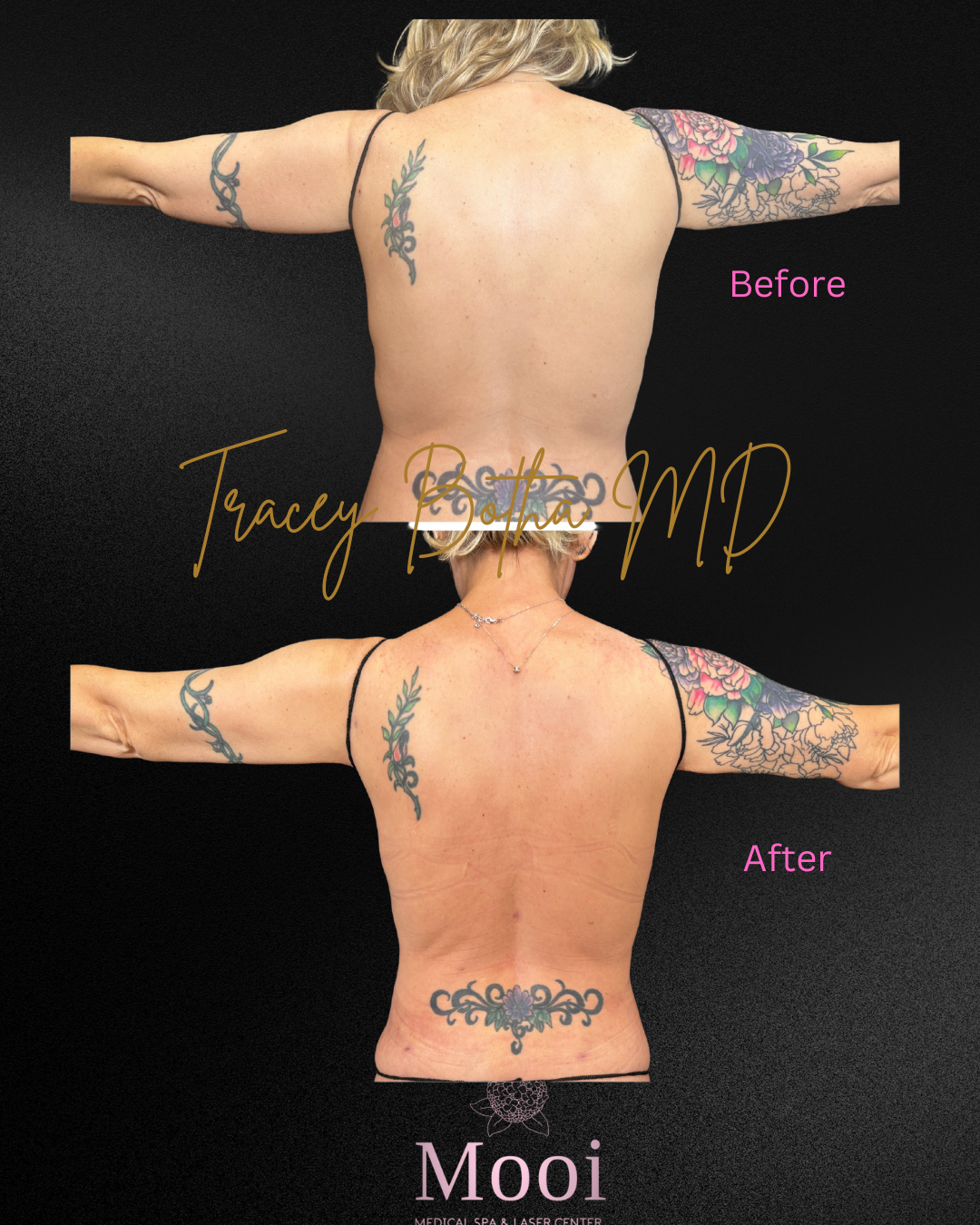 before and after photo of a woman holding arms out to show arm liposuction results with tattoos