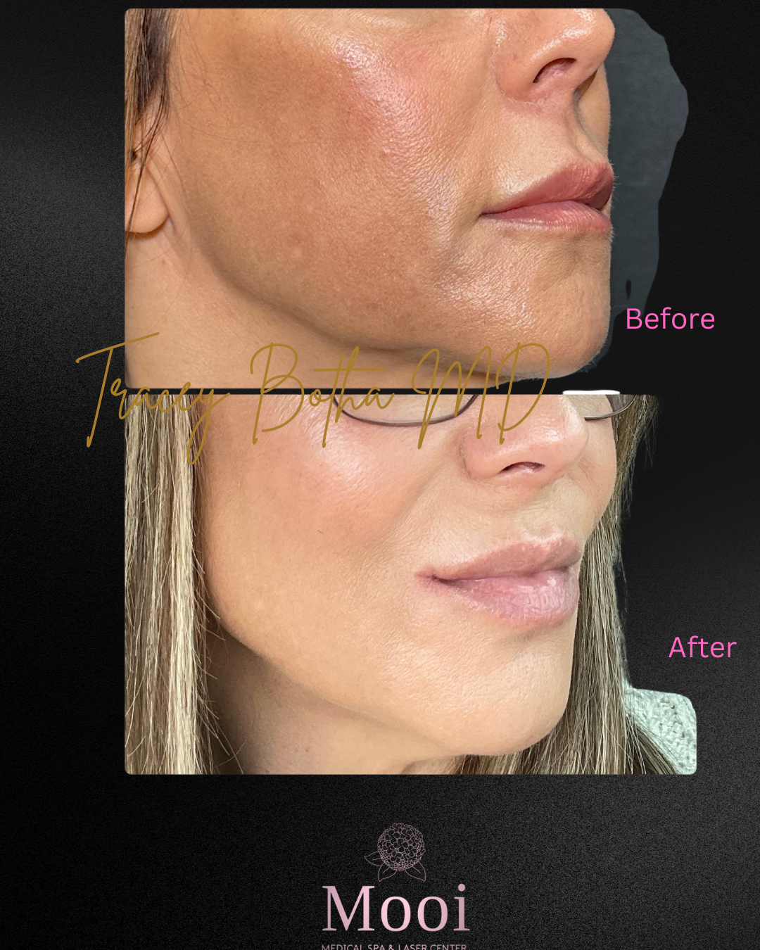 before and after of womans cheek for melasma 