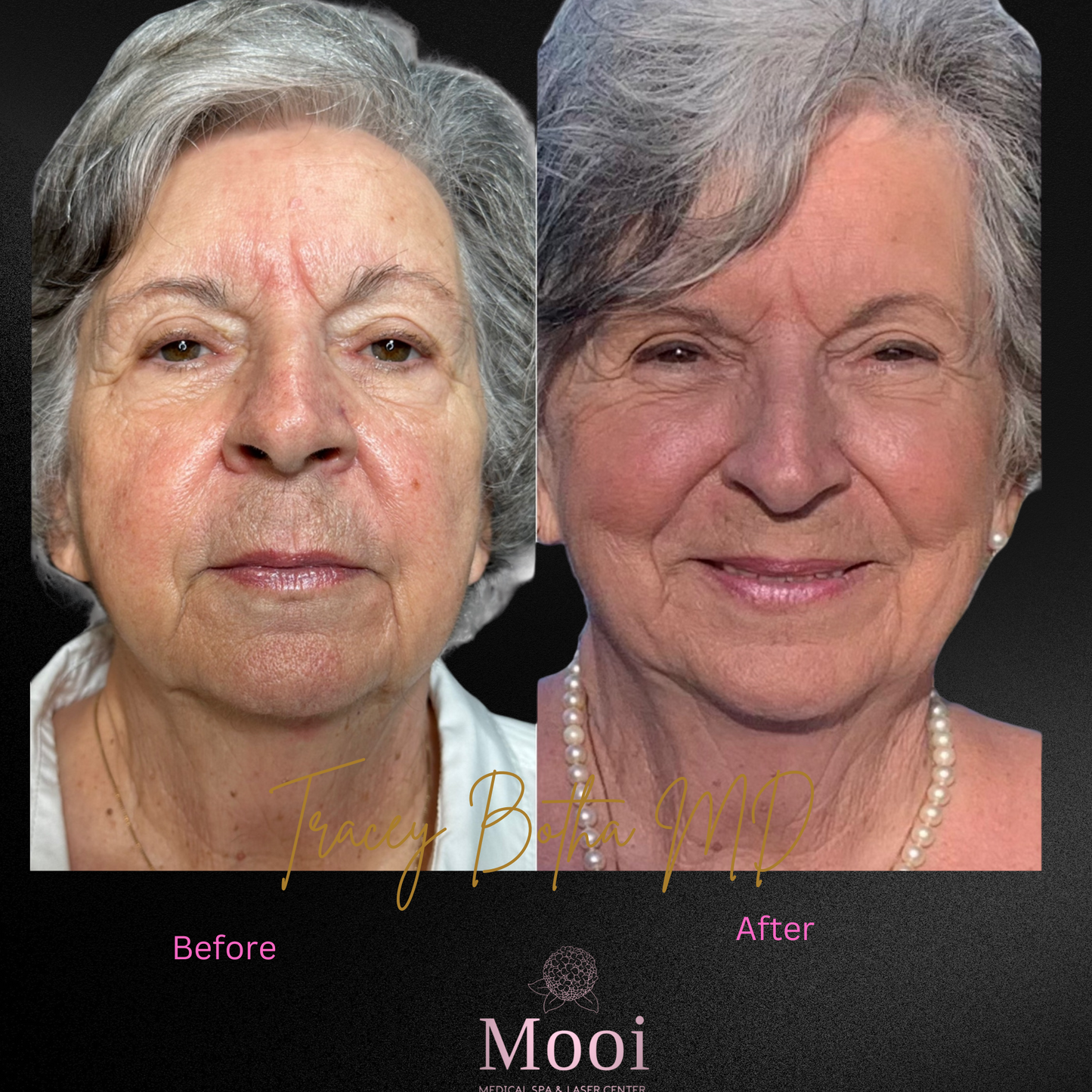 older woman with grey hair smiling before and after microneedling treatment