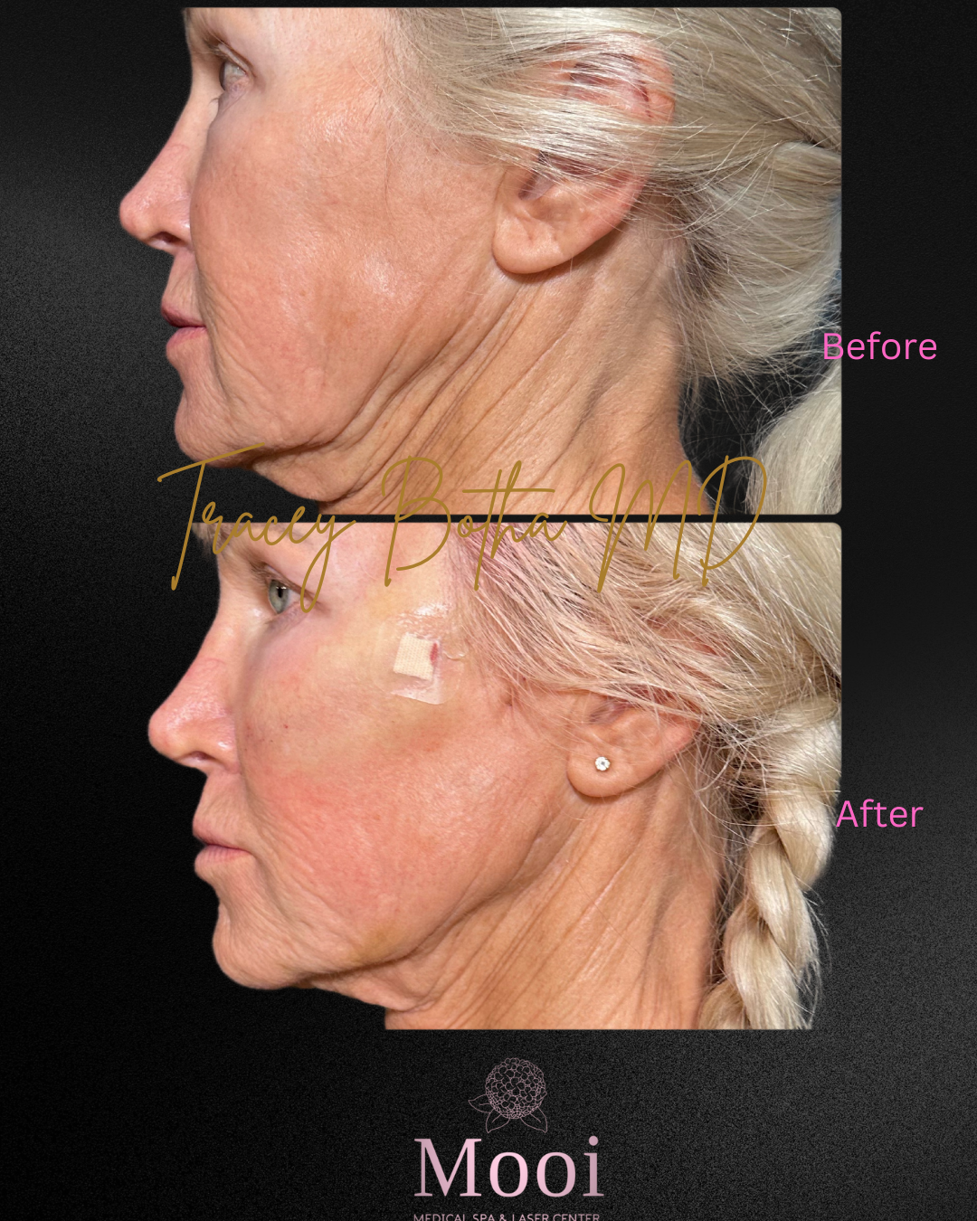 before and after of older woman with neck botox 