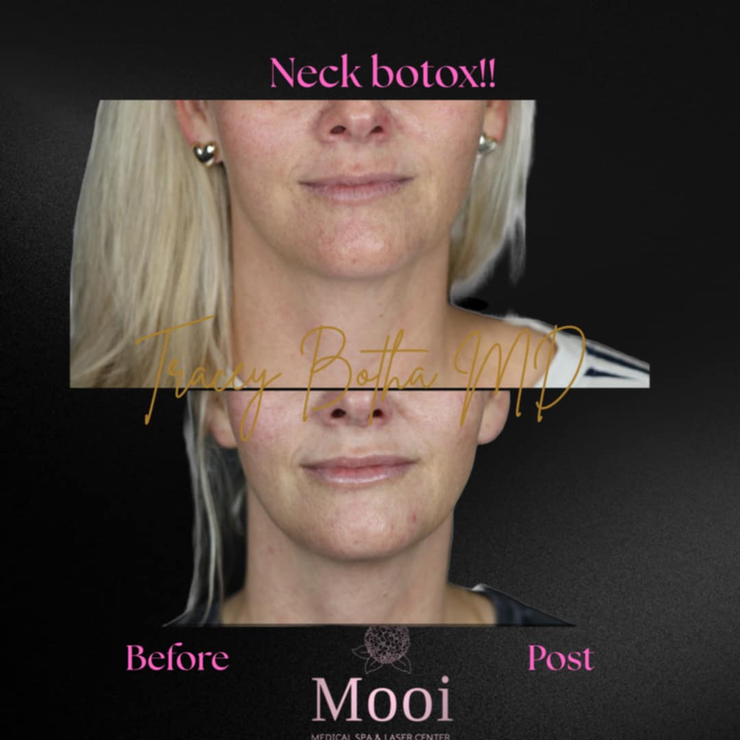 Botox