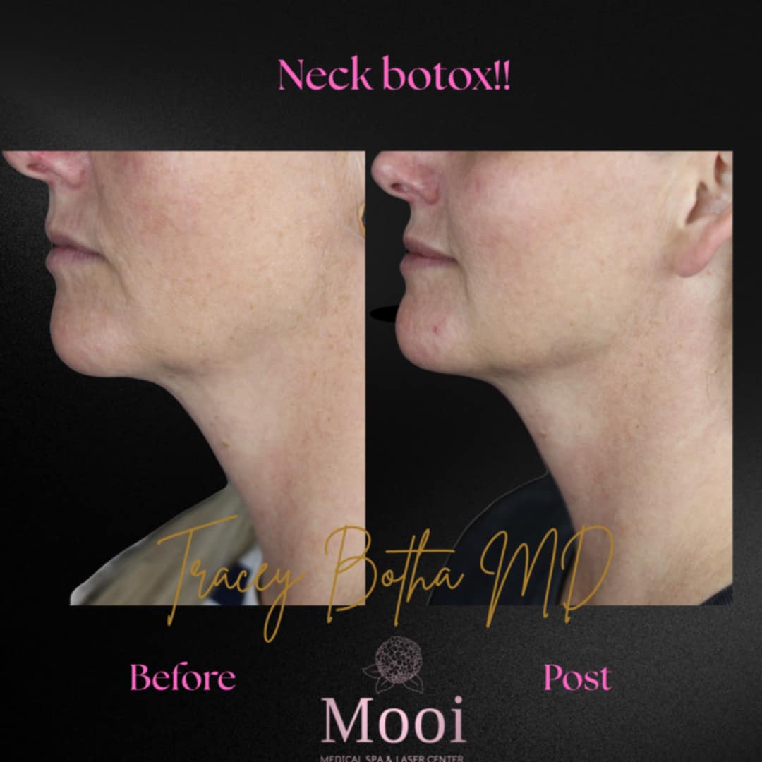 Botox