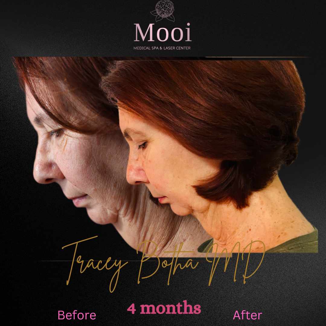 before and after image of neck tightening on middle age woman side profile with chin tucked