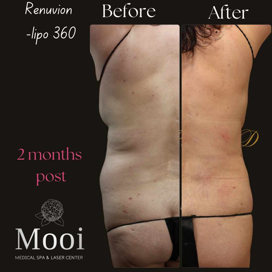 Rear view of liposuction on womans flanks before and after