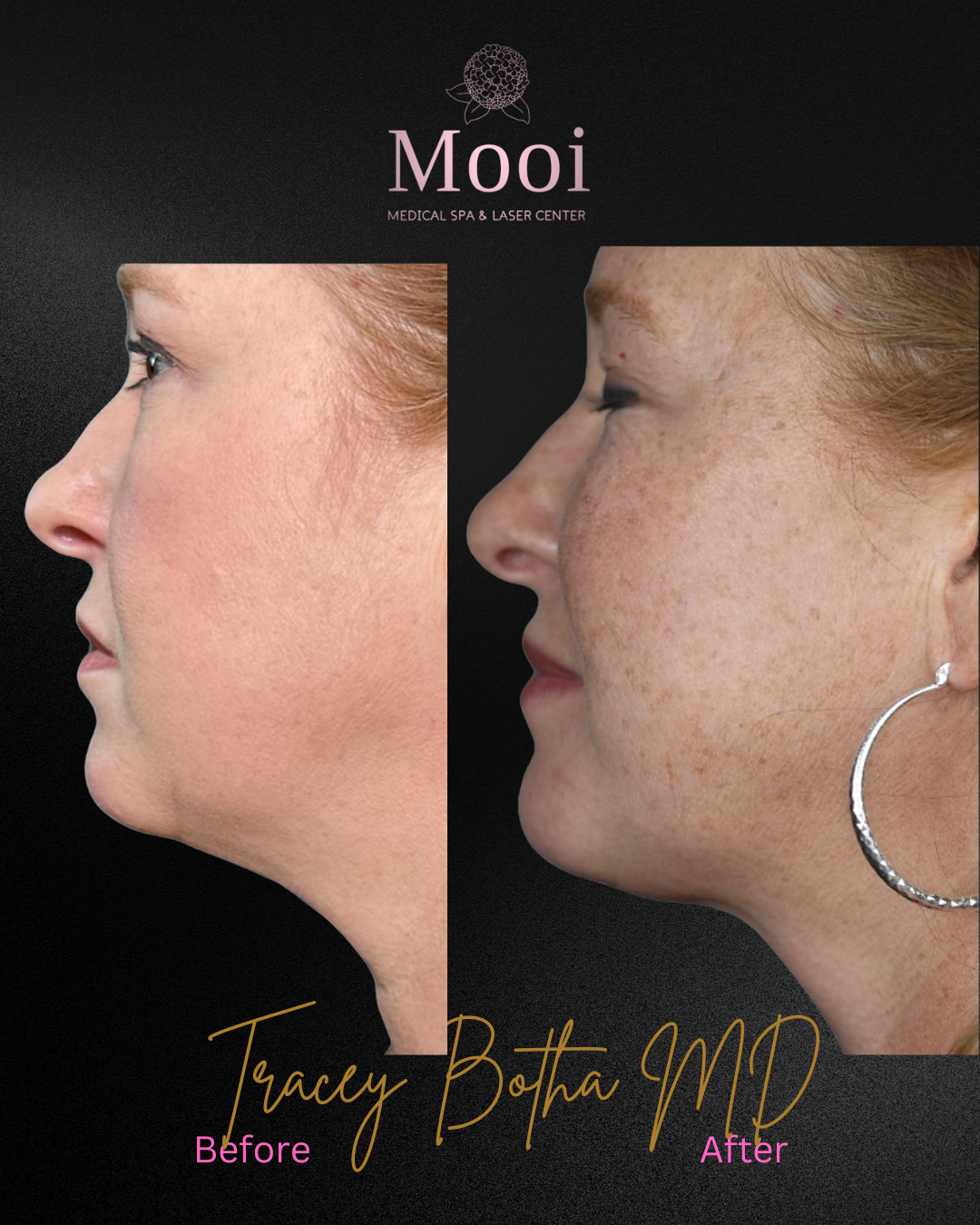 before and after image of neck tightening on middle aged woman with freckles