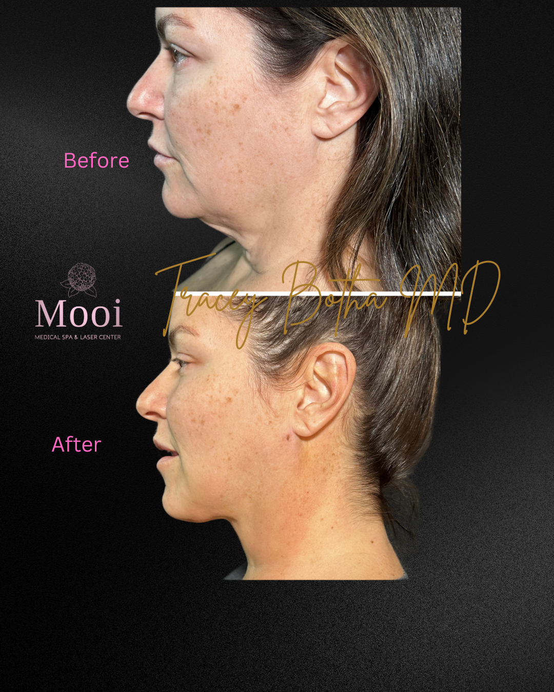 woman with brown hair before and after image of neck tightening procedure