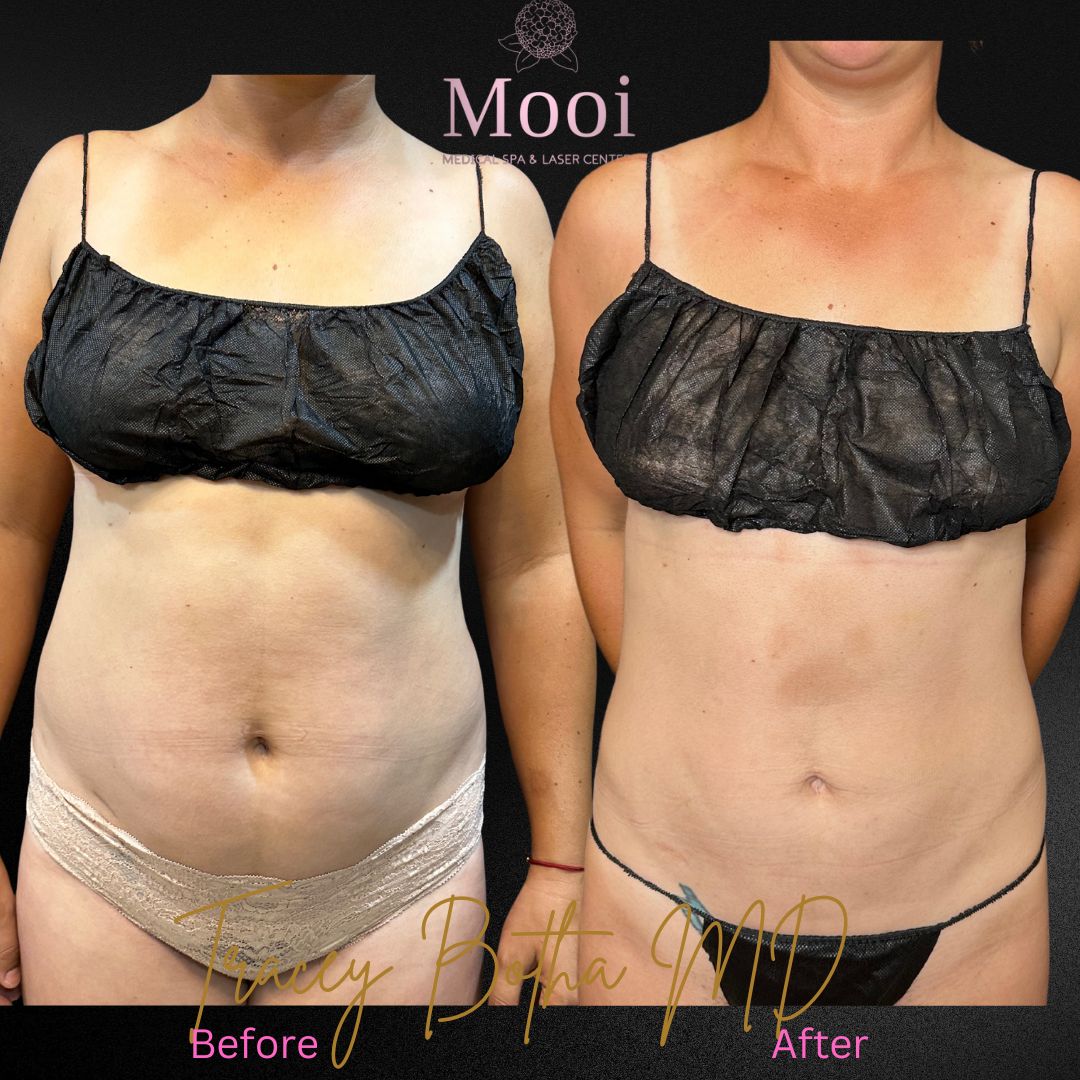 before and after of body sculpting on you woman torso front view