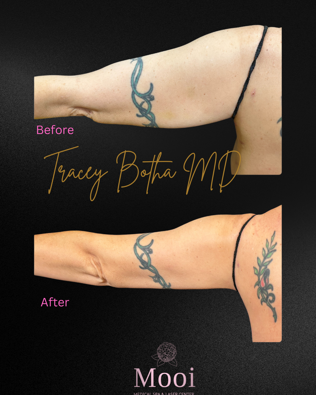 Before and after of arm held out with tattoo 