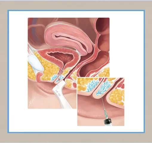Illustration of a female reproductive system with a focus on the clitoris and surrounding area, indicating a targeted injection site for a climax shot. The image includes a close-up of a woman's genitals and a syringe for injecting.