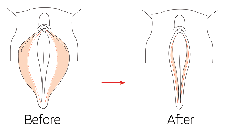 Illustration of the anatomical target area for non-surgical labiaplasty, with a before and after comparison of the labia's appearance.