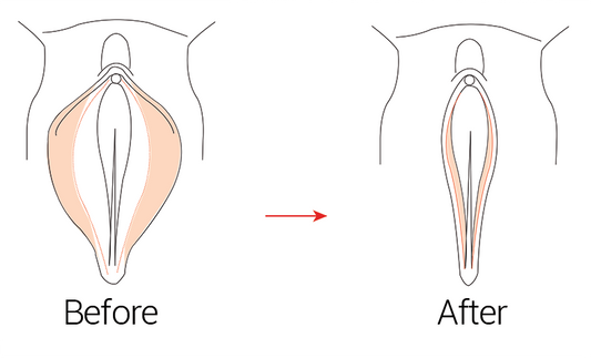 Illustration of the anatomical target area for non-surgical labiaplasty, with a before and after comparison of the labia's appearance.