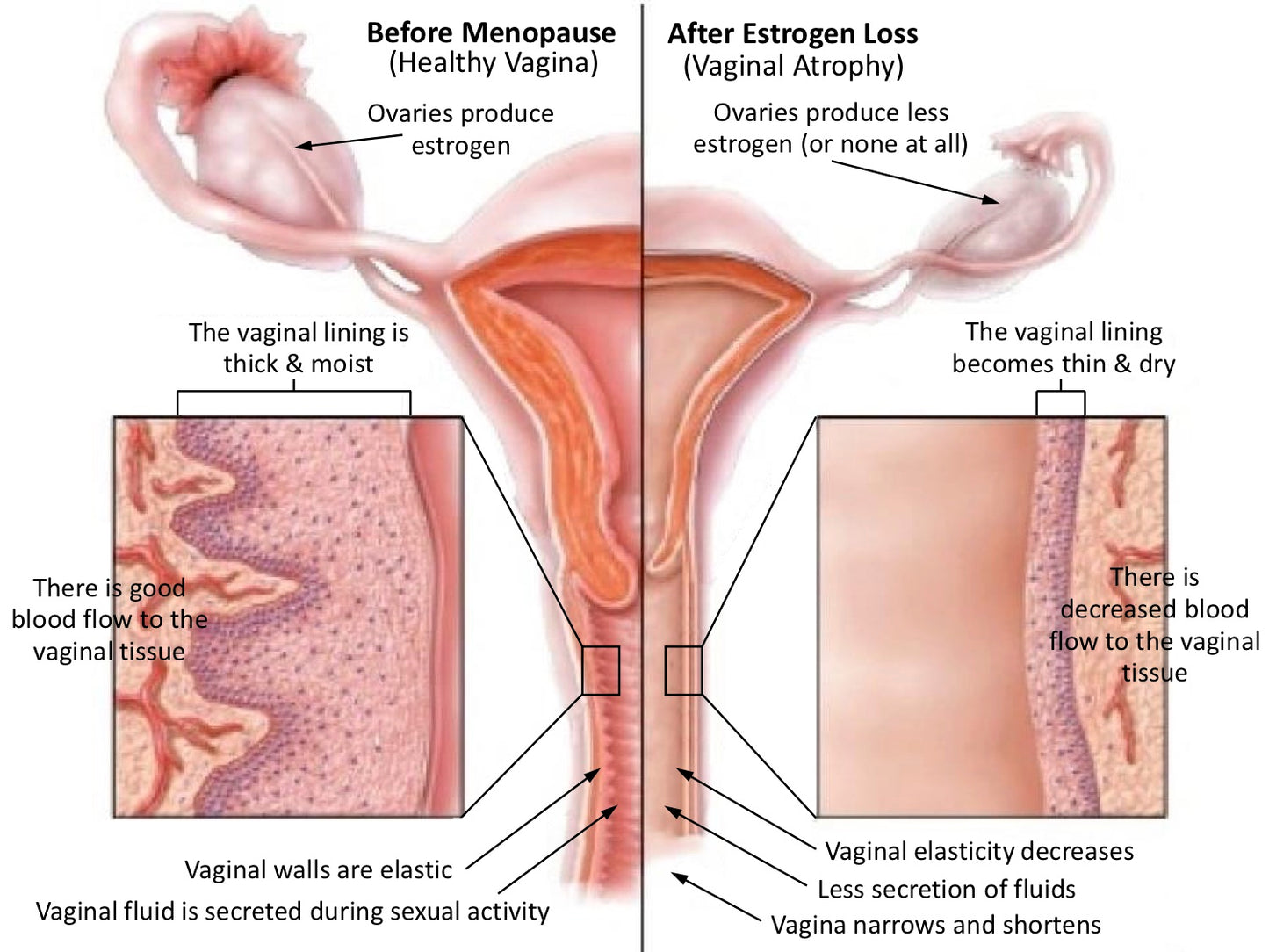 Vaginal Rejuvination